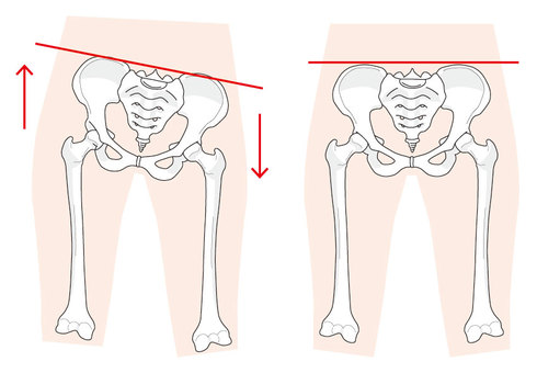 それではまず骨盤の一般的な歪み方を見ていきます