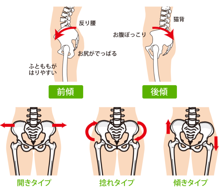 それではまず骨盤の一般的な歪み方を見ていきます