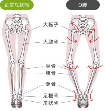 O脚とは