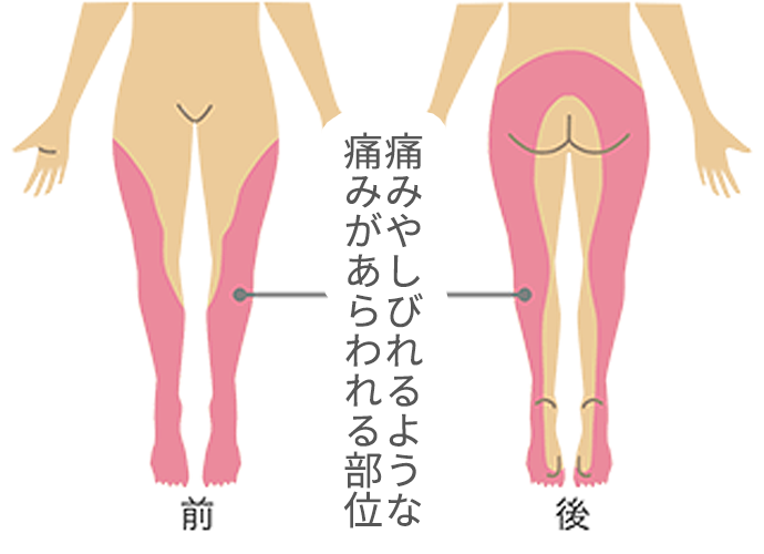 坐骨神経痛とは？